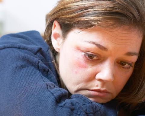 Woman with black eye rests her chin on her arms on a table